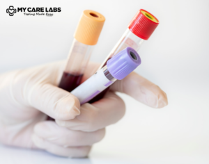 High Gamma GT Levels in Blood Tests