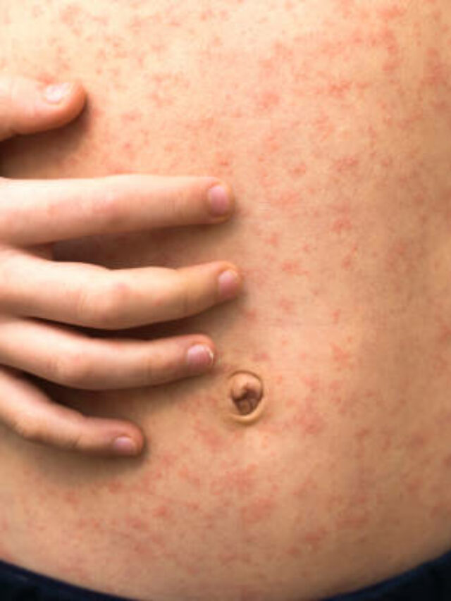 CDC Issues Measles Alert