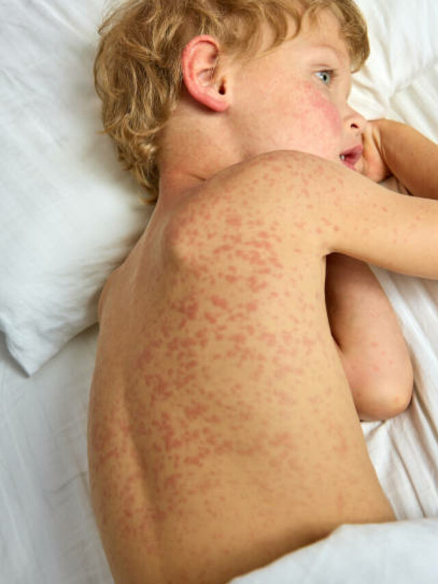 Measles Exposure in CA