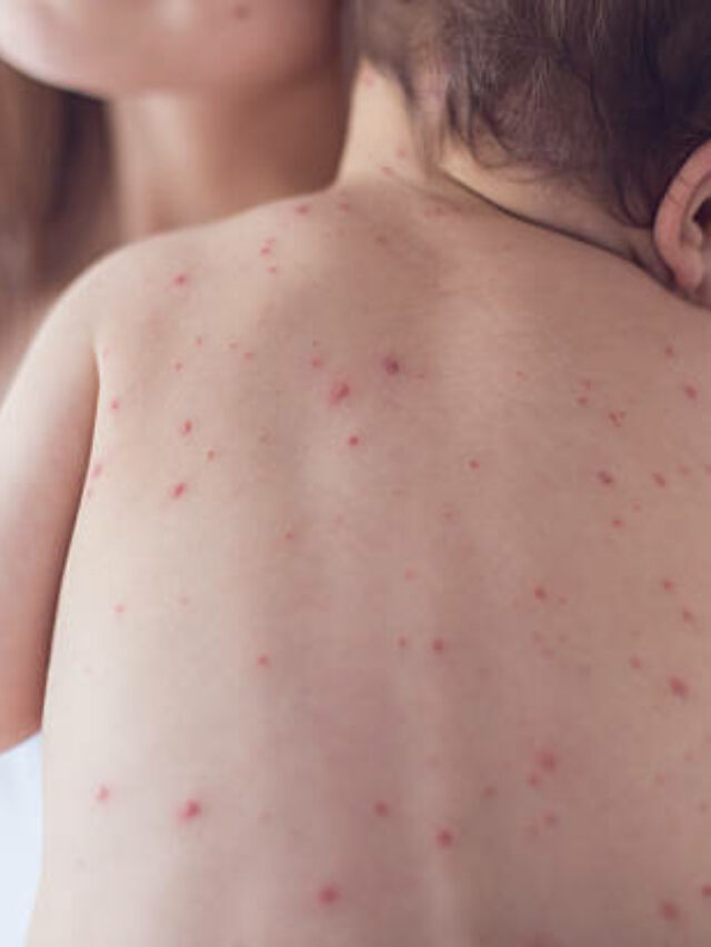 Measles exposure reported at SF Bay Area